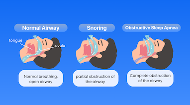 آپنه خواب و نکاتی که باید بدانید